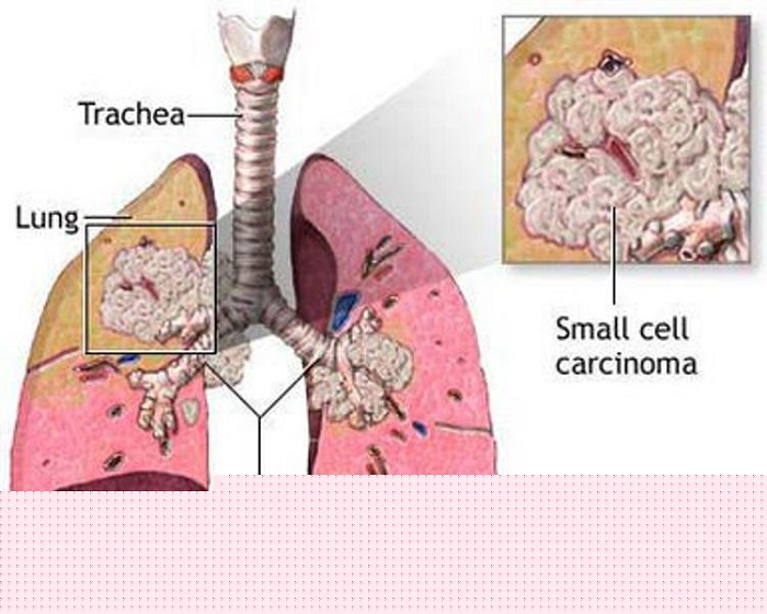 Ảnh 1 của Ung thư phổi tế bào nhỏ (SCLC)